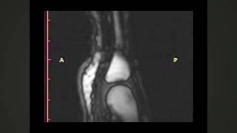 تصویر MRI شکستن قولنج انگشت پریناز ایزدیار
