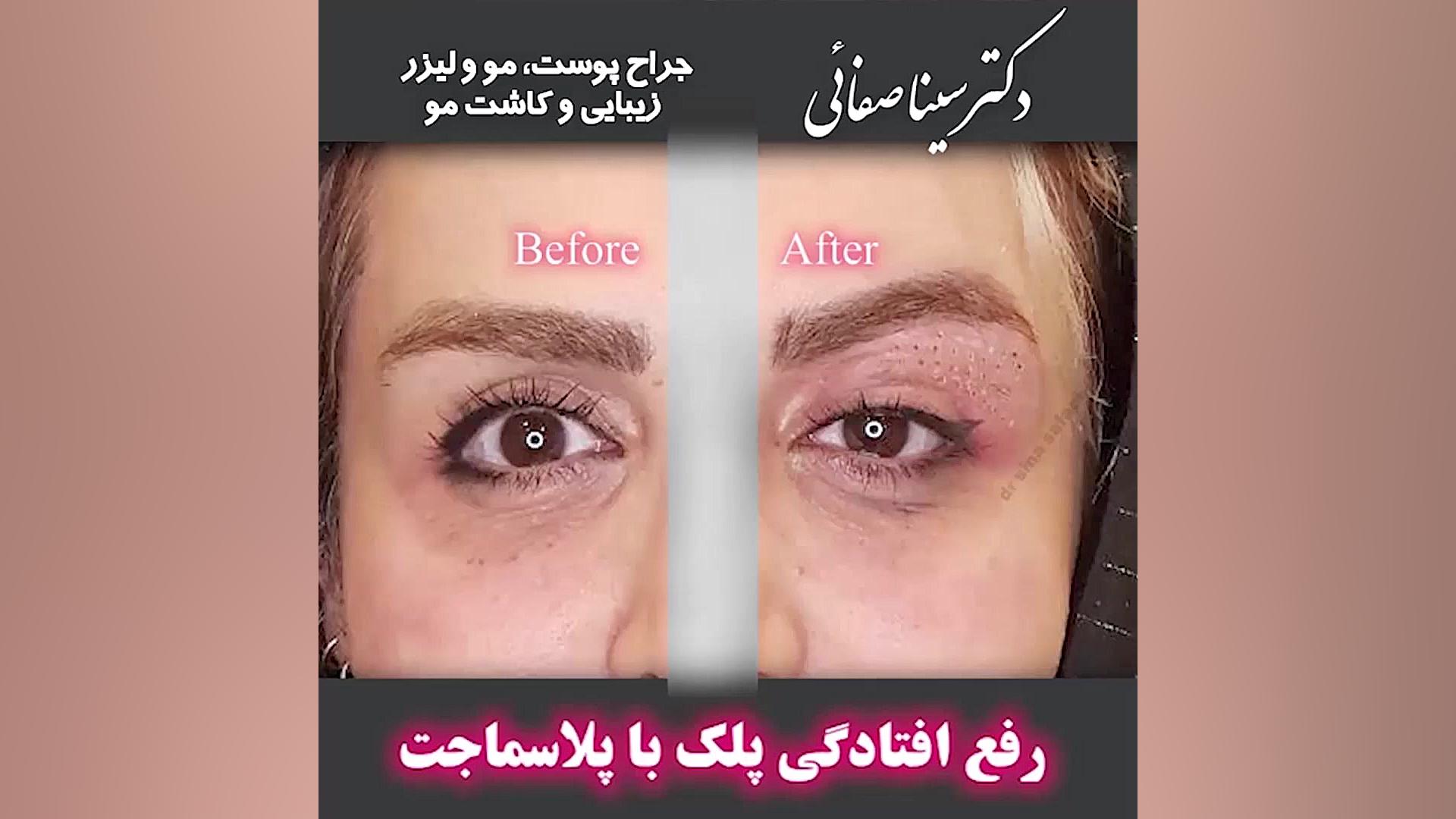 رفع افتادگی پلک با پلاسما جت ربات جراحی داوینچی