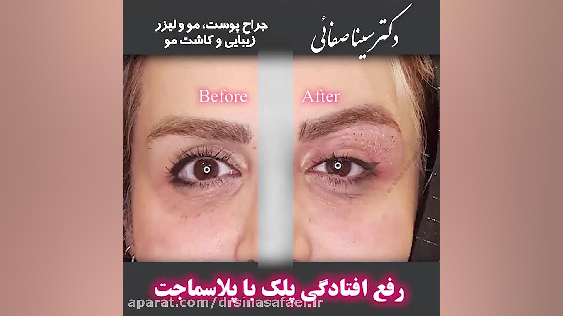 رفع افتادگی پلک با پلاسما جت مهندسی ژنوم انسانی