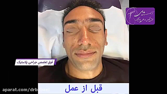 فیلم واقعی تزریق نانوفت دکتر کامران بابایی