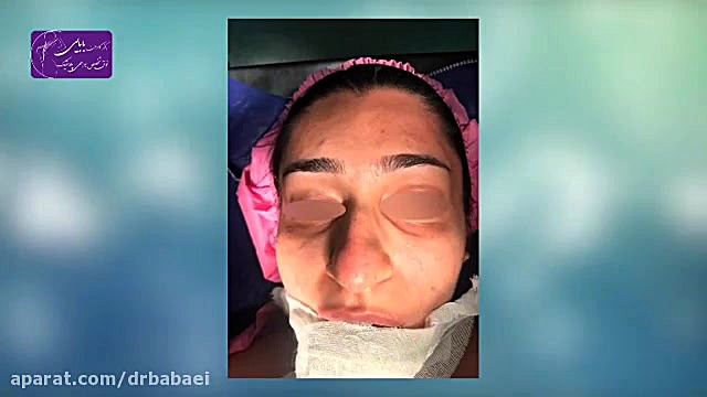 فیلم واقعی از جراحی زیبایی بینی سخت! دکتر کامران بابایی