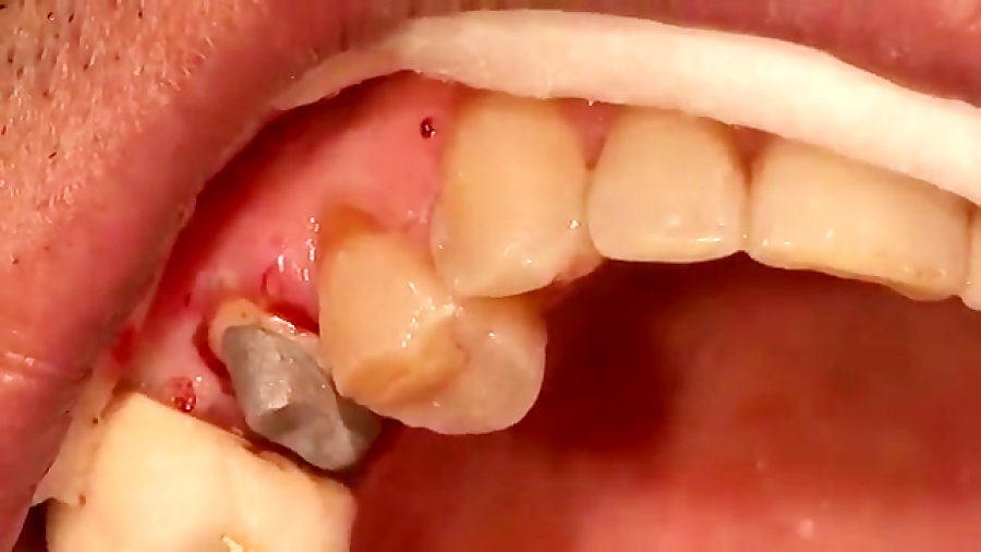کیت بلیچینگ - Step to Smile kit بلیچینگ