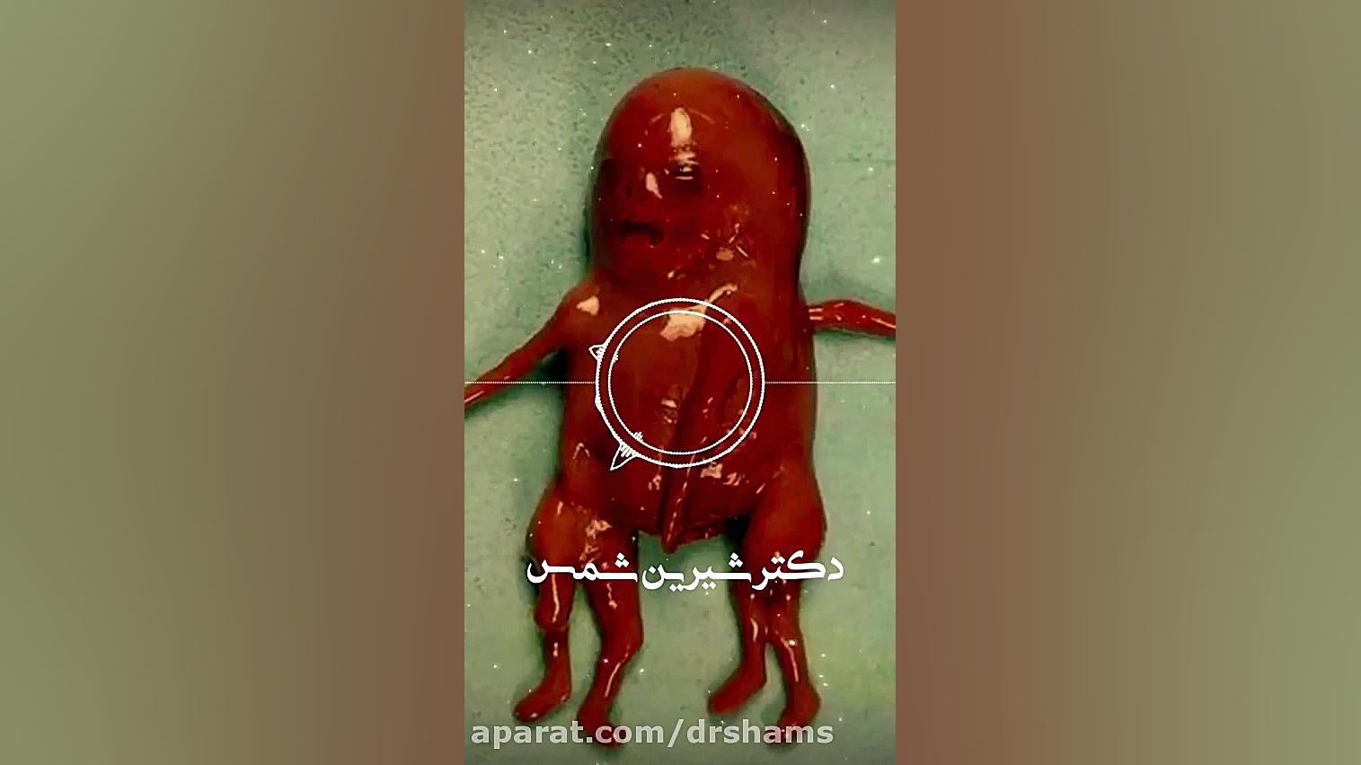 فیلم جنین با یک سر و دو بدن دکتر شیرین شمس جراح و متخصص زنان و زایمان