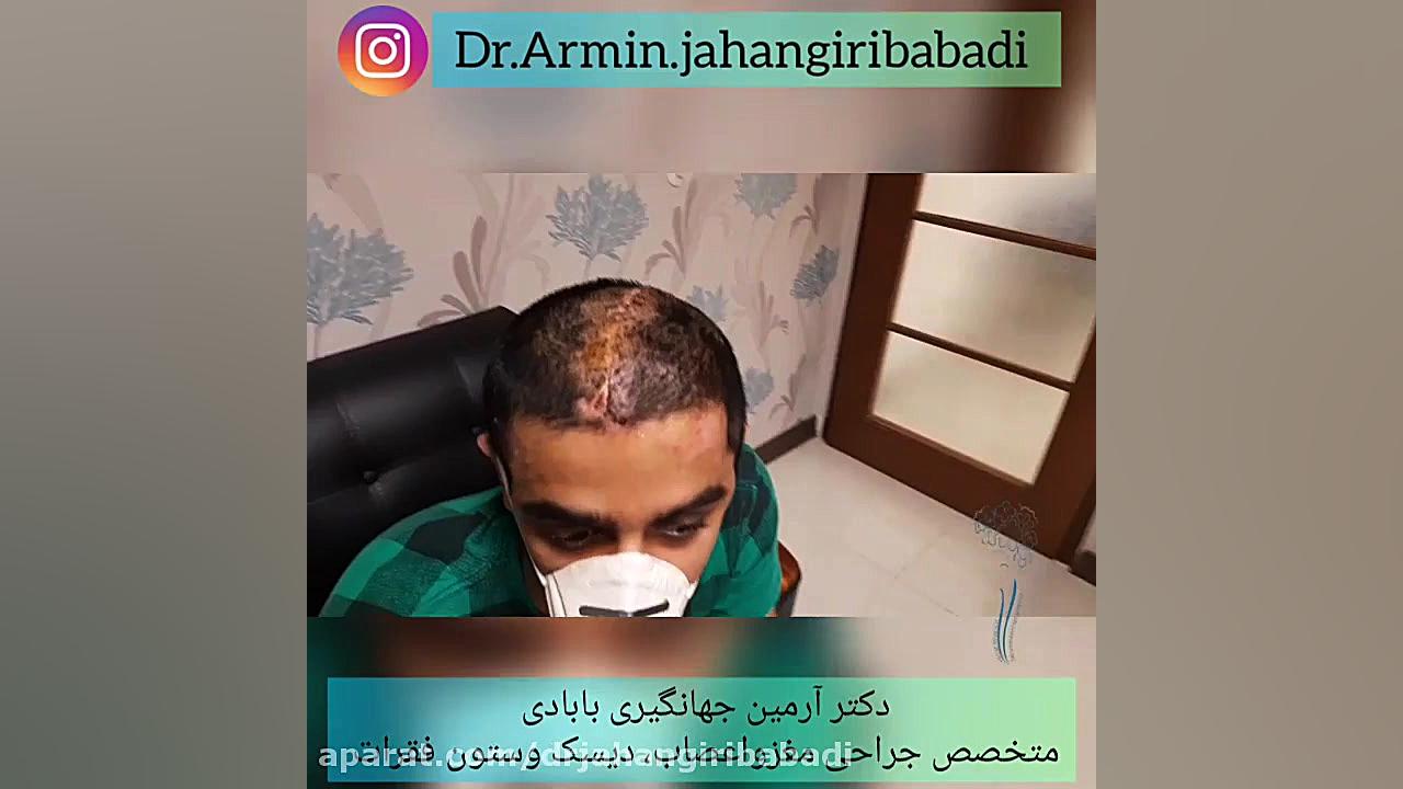عمل جراحی خونریزی مغزی وسپس عمل ترمیم استخوان جمجمه ووضعیت بهبودی بیمار کشیدن دندان
