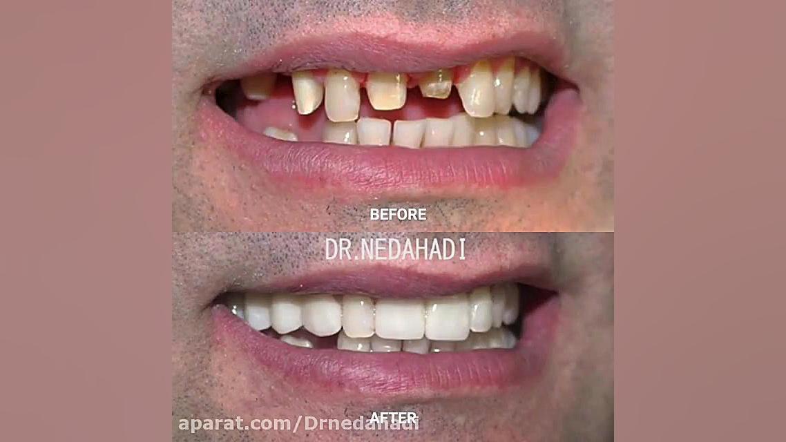 روکش زیبایی و لمینیت سرامیکی دکتر ندا هادی-دندانپزشک زیبایی