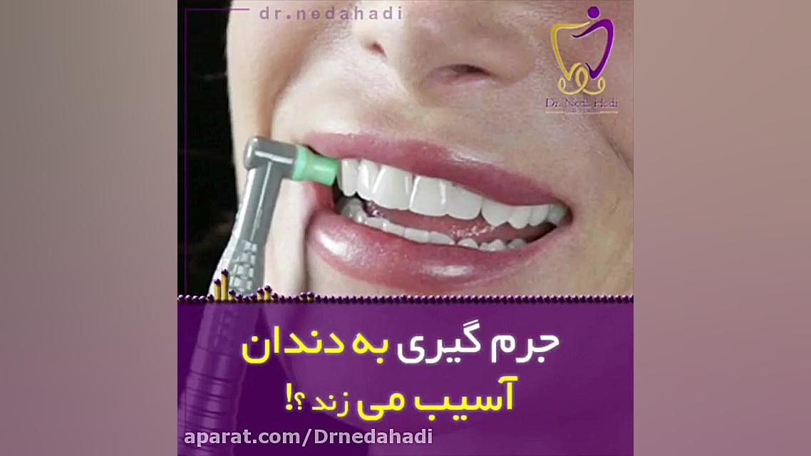ایا جرمگیری به دندان آسیب می زند؟ دکتر ندا هادی-دندانپزشک زیبایی