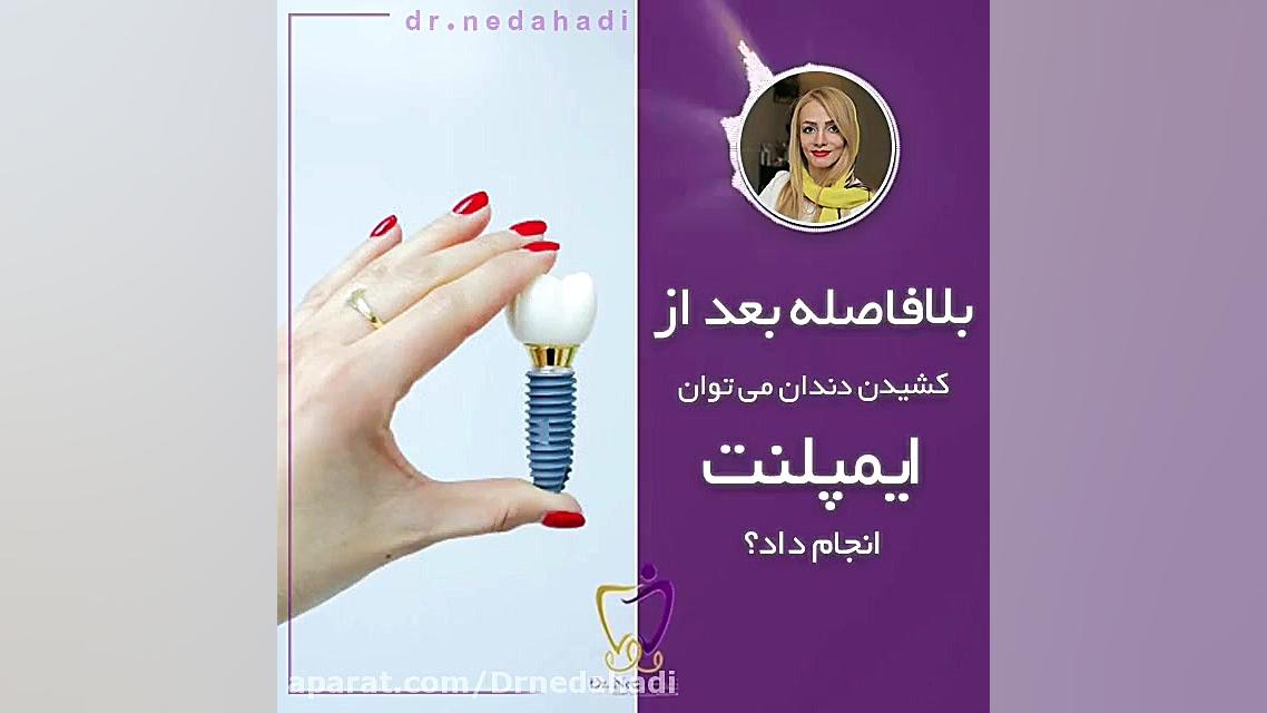 بلافاصله بعد از کشیدن دندان می توان ایمپلنت انجام داد؟ دکتر ندا هادی-دندانپزشک زیبایی