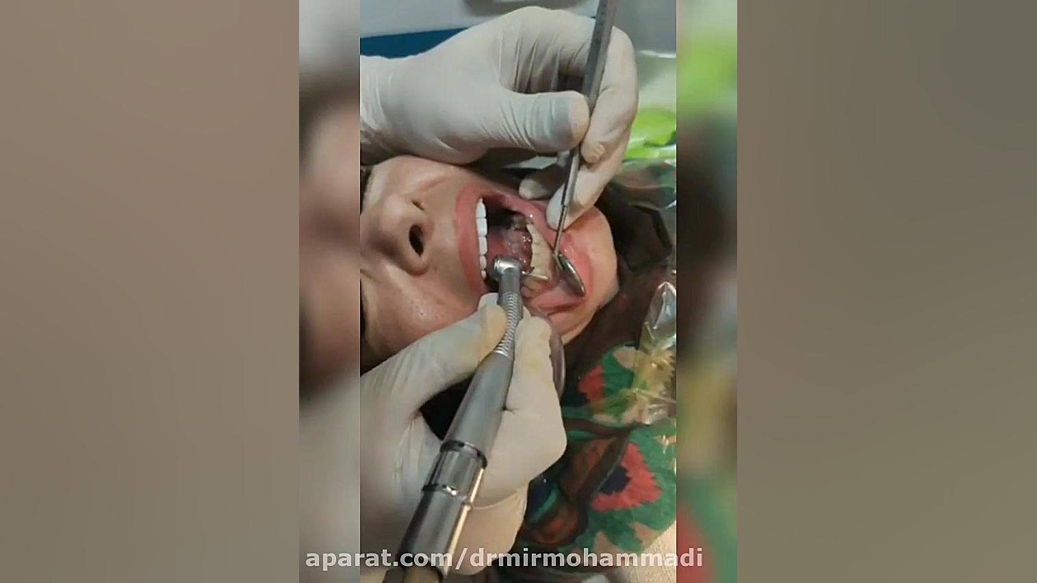 کامپوزیت ونیر فک پایین با حداقل تراش ساکوبیتریل