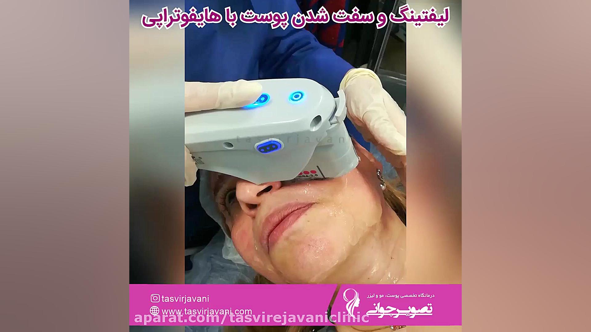 لیفتینگ و سفت شدن پوست با هایفوتراپی کاشت ریش