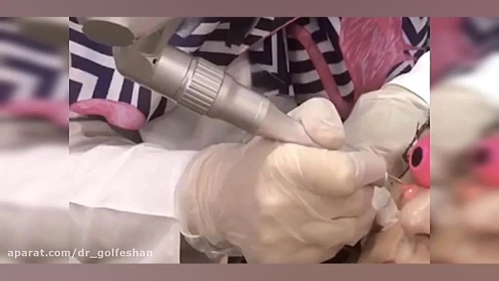 درمان زانتلاسما با لیزر دکتر عاطفه گلفشان، متخصص پوست مو و لیزر درمانی