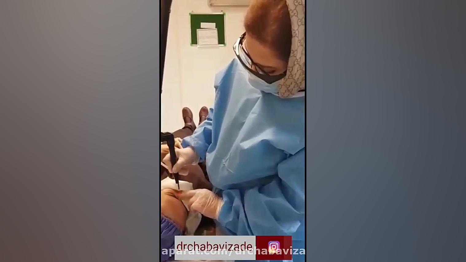 فیلم برداشتن خال به روش توام تراش و لیزر دکتر صفیه چعباوی زاده