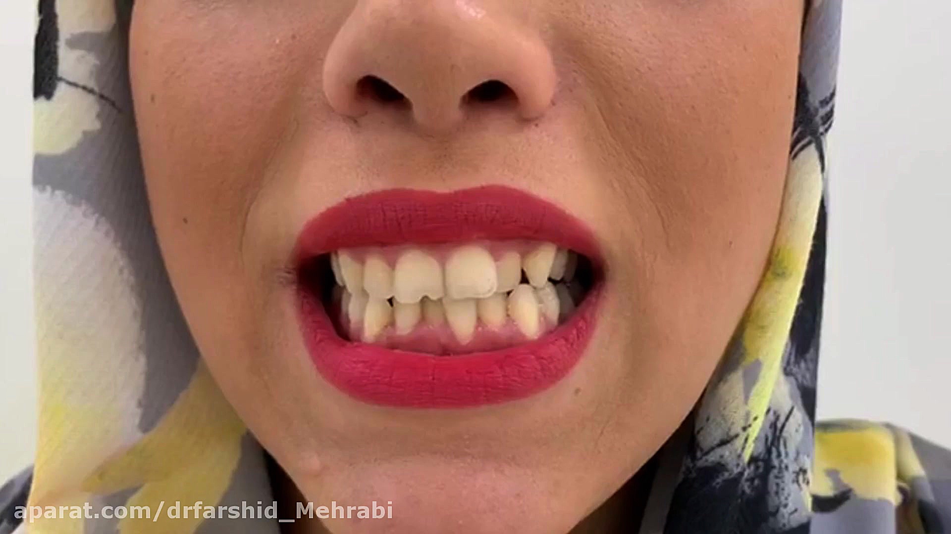 فیلم کامپوزیت دندان ایمونوانژیوگرافی