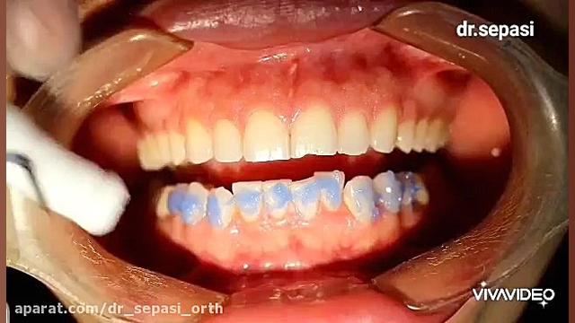 مراحل نصب براکت ارتودنسی به روش indirect bonding توسط دکتر سپاسی ارتودنسی اهواز دکتر سپهر سپاسی متخصص ارتودنسی