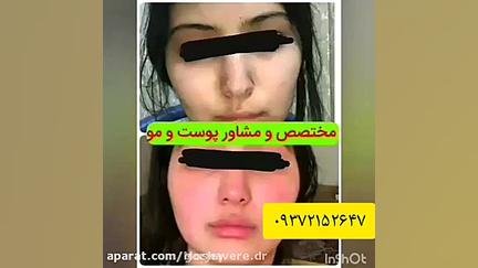رفع لکه های پوستی و جای جوش کاملا تضمینی پالپوتومی
