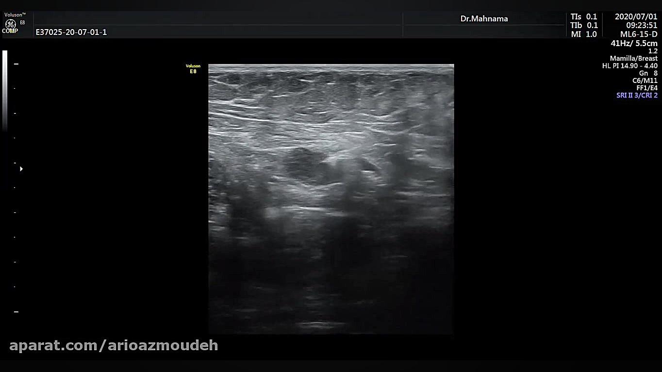 آسپیراسیون سوزنی نازک FNA آهو خمیازه