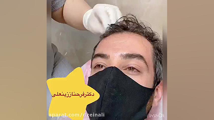 مزوتراپی کف سر دکتر فرحناز زینعلی - متخصص پوست، مو، زیبایی زنجان