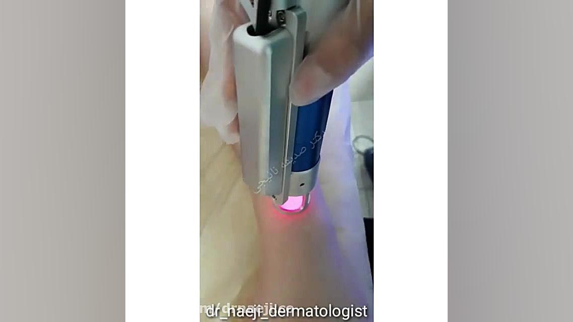 فیلم لیزر موهای زائد دکتر صدیقه نائیجی | متخصص پوست و مو در قم