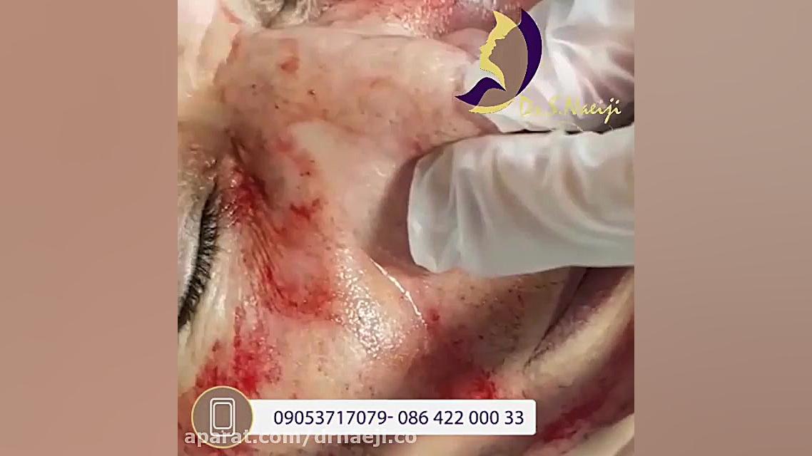 فیلم میکرونیدلینگ با prp درمان ریزش مو