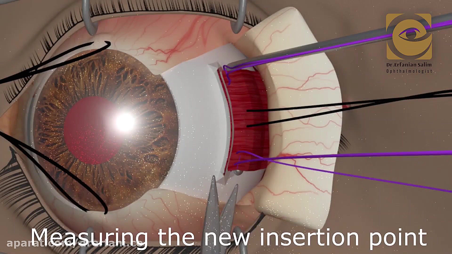 فیلم جراحی انحراف چشم به روش رسسشن بیماری سندرم فریمن شلدون