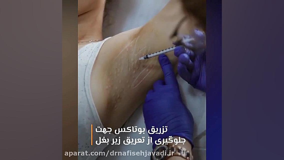 تزریق بوتاکس جهت جلوگیری از تعریق زیر بغل لیفت گردنایمپلنت دندان