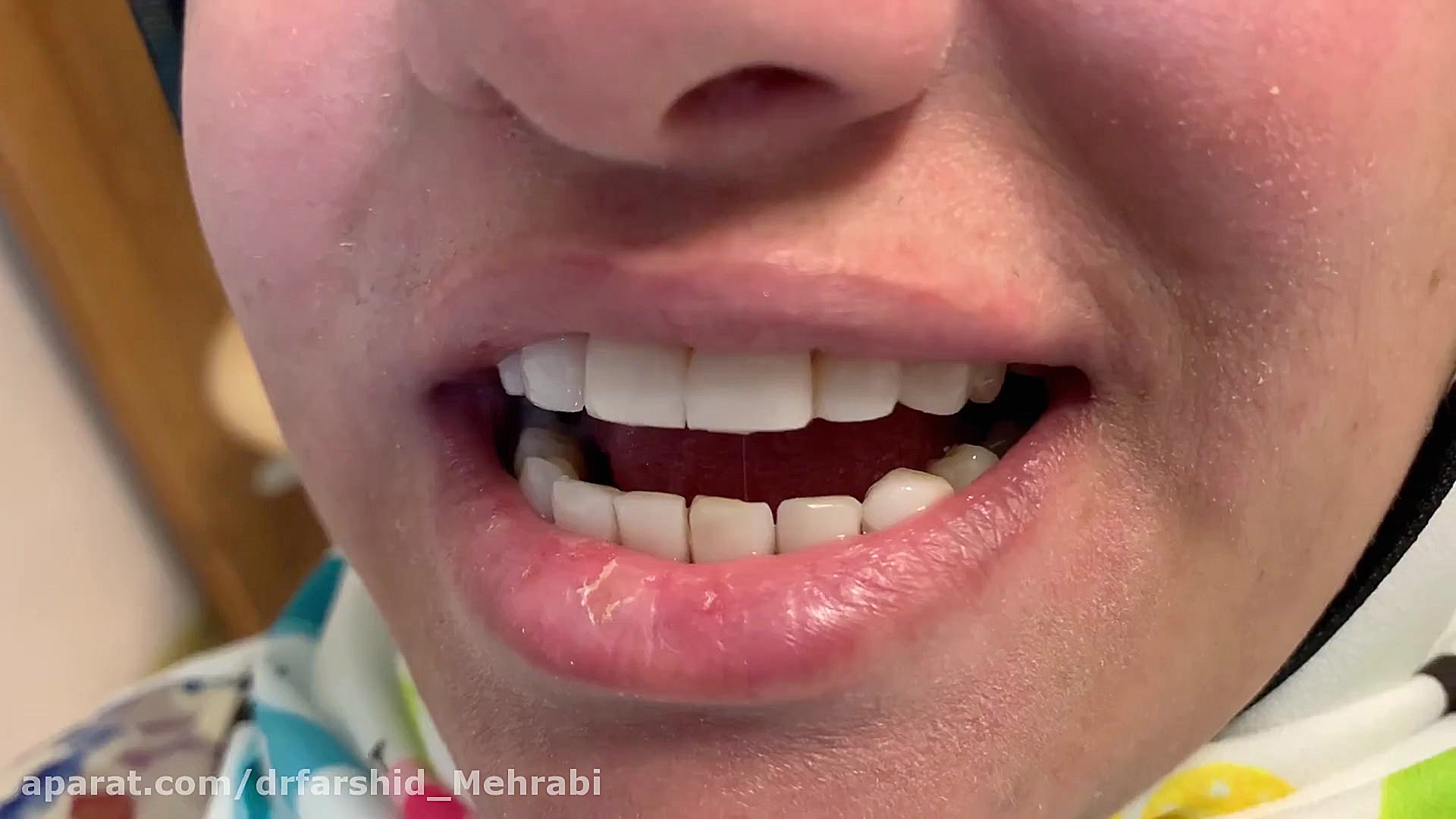 فیلم کامپوزیت دندان و بستن فاصله بین دندانها SVR