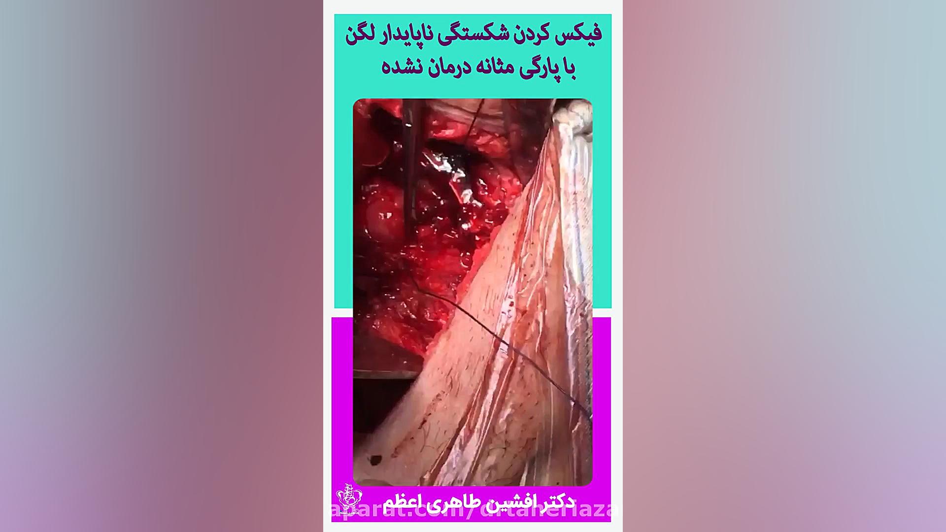 فیکس کردن شکستگی ناپایدار لگن با پارگی مثانه درمان نشده - دکتر طاهری اعظم برد پیت