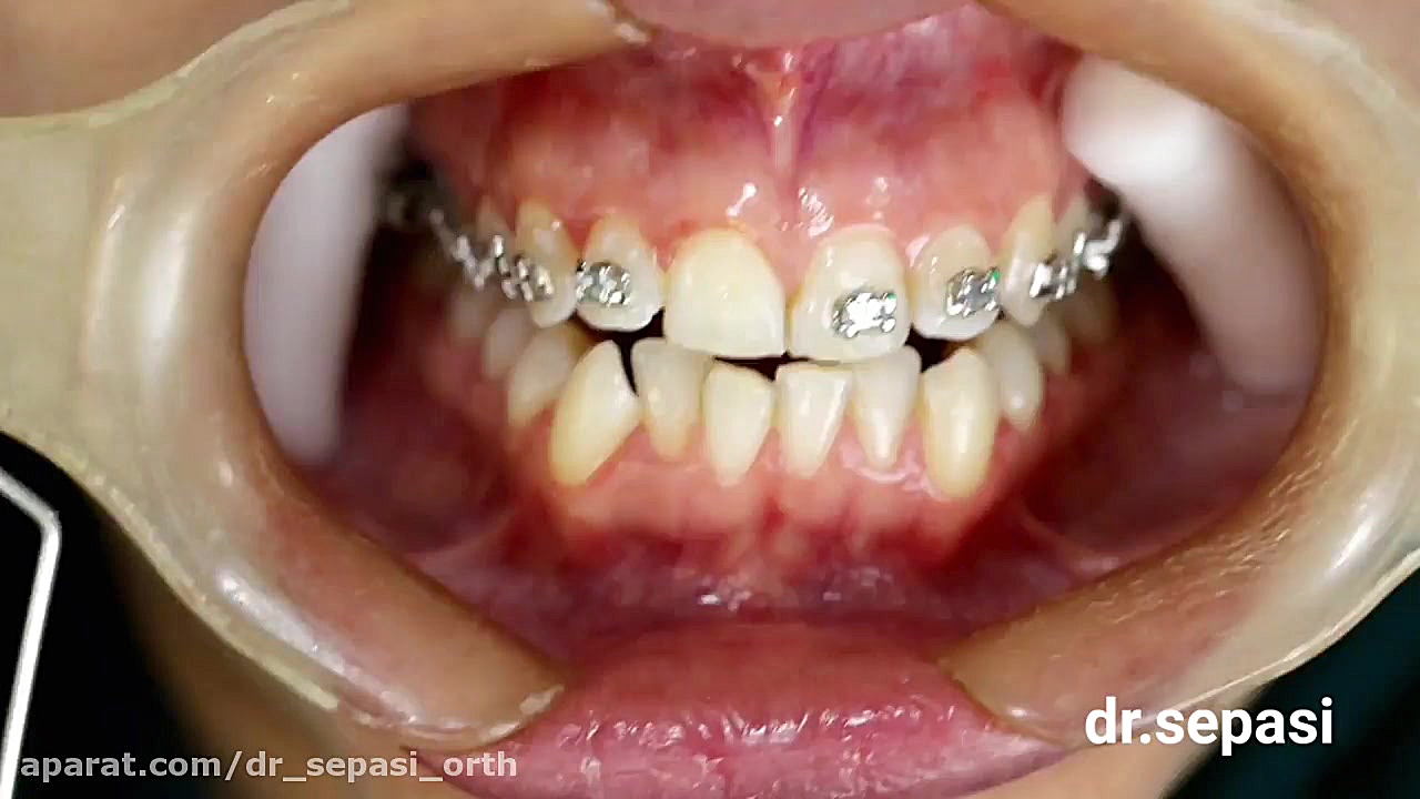 مراحل نصب ارتودنسی دکتر سپاسی متخصص ارتودنسی اهواز به روش Direct Bonding دکتر سپهر سپاسی متخصص ارتودنسی