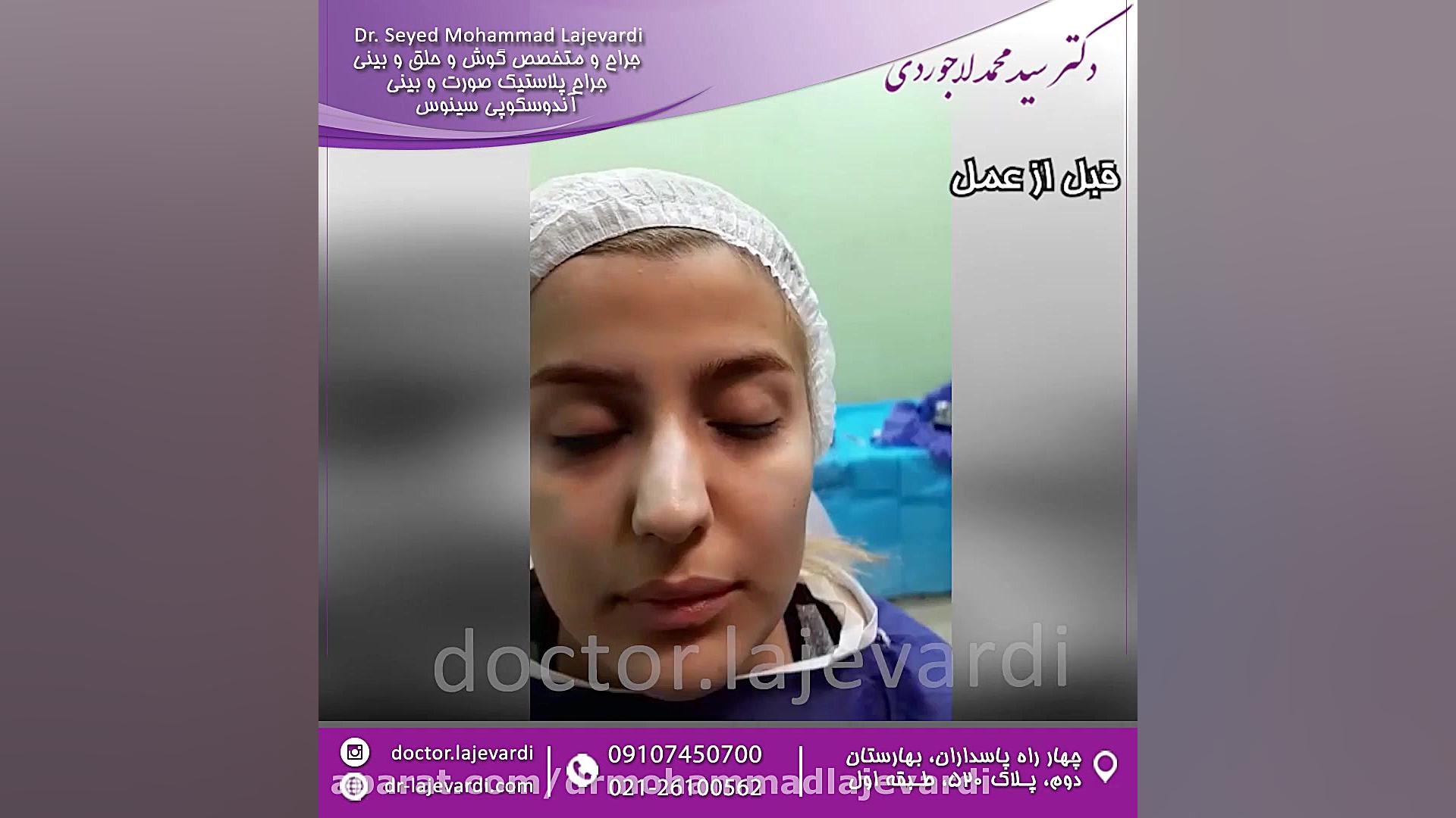 عمل زیبایی بینی بدون بیهوشی باند ضد باکتری نانو
