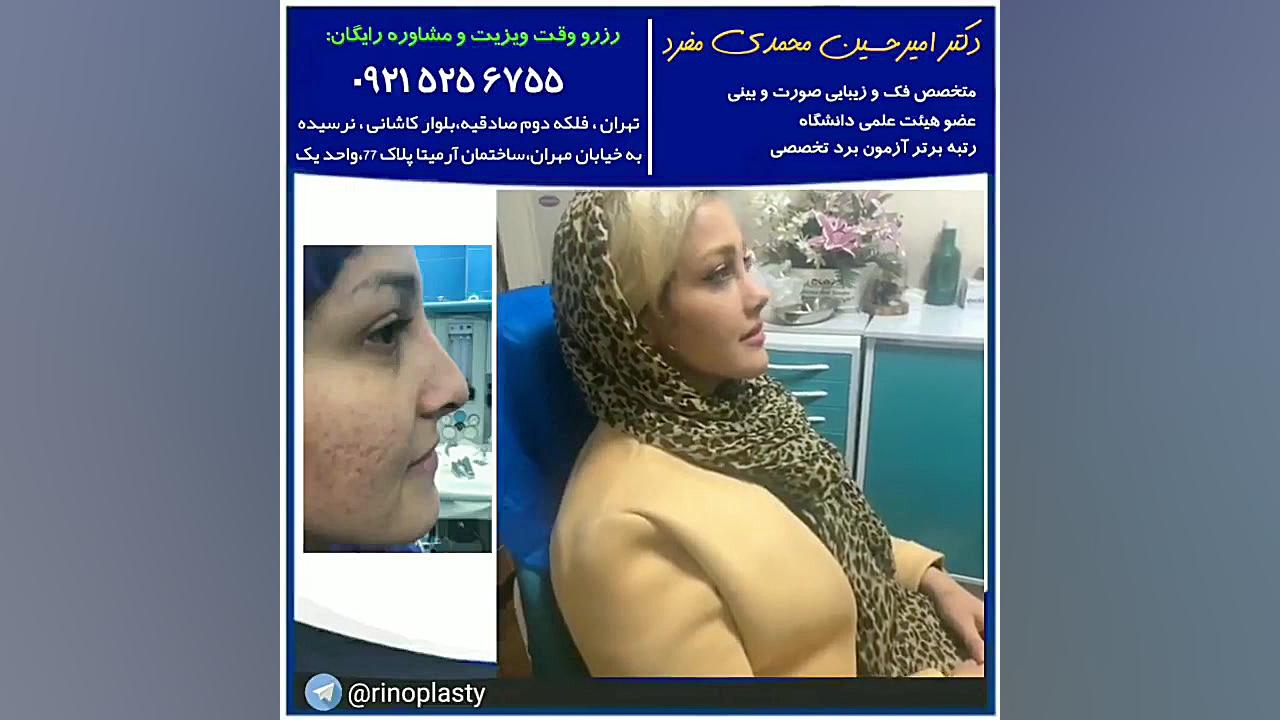 عمل زیبایی بینی دکتر محمدی مفرد(09215256755) دکتر امیر حسین محمدی مفرد