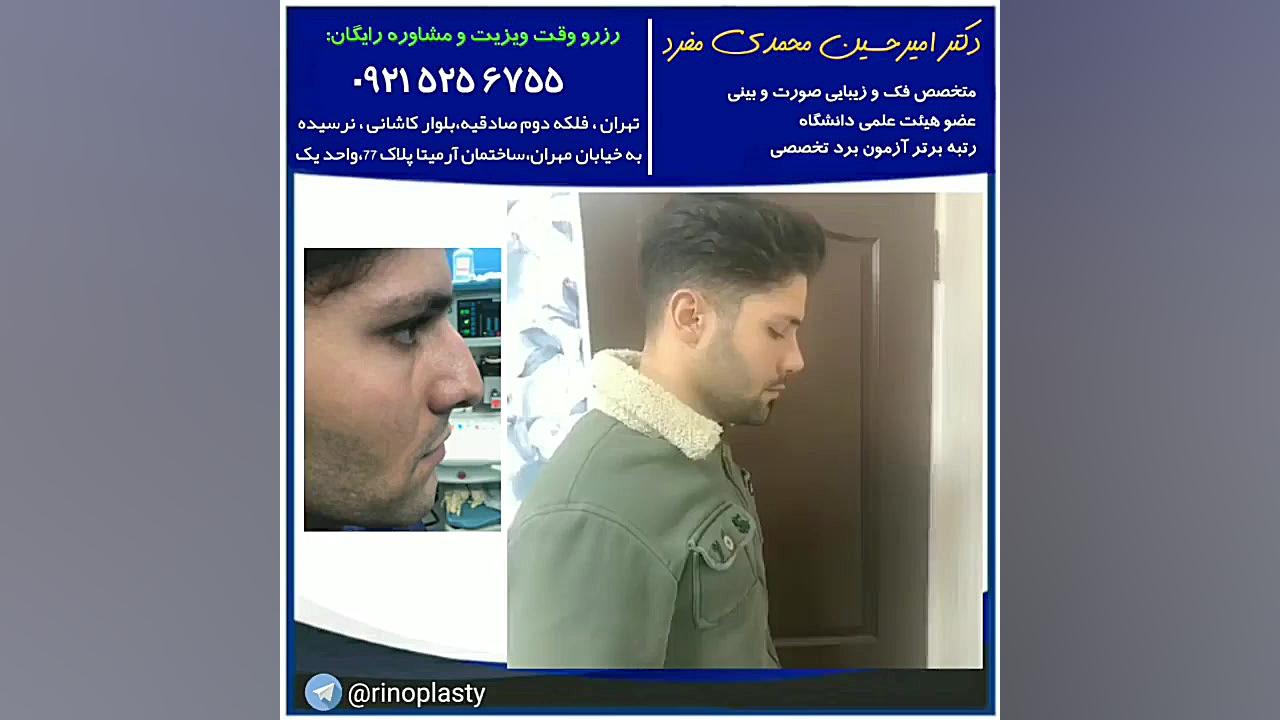 عمل زیبایی بینی دکتر محمدی مفرد(09215256755) دکتر امیر حسین محمدی مفرد
