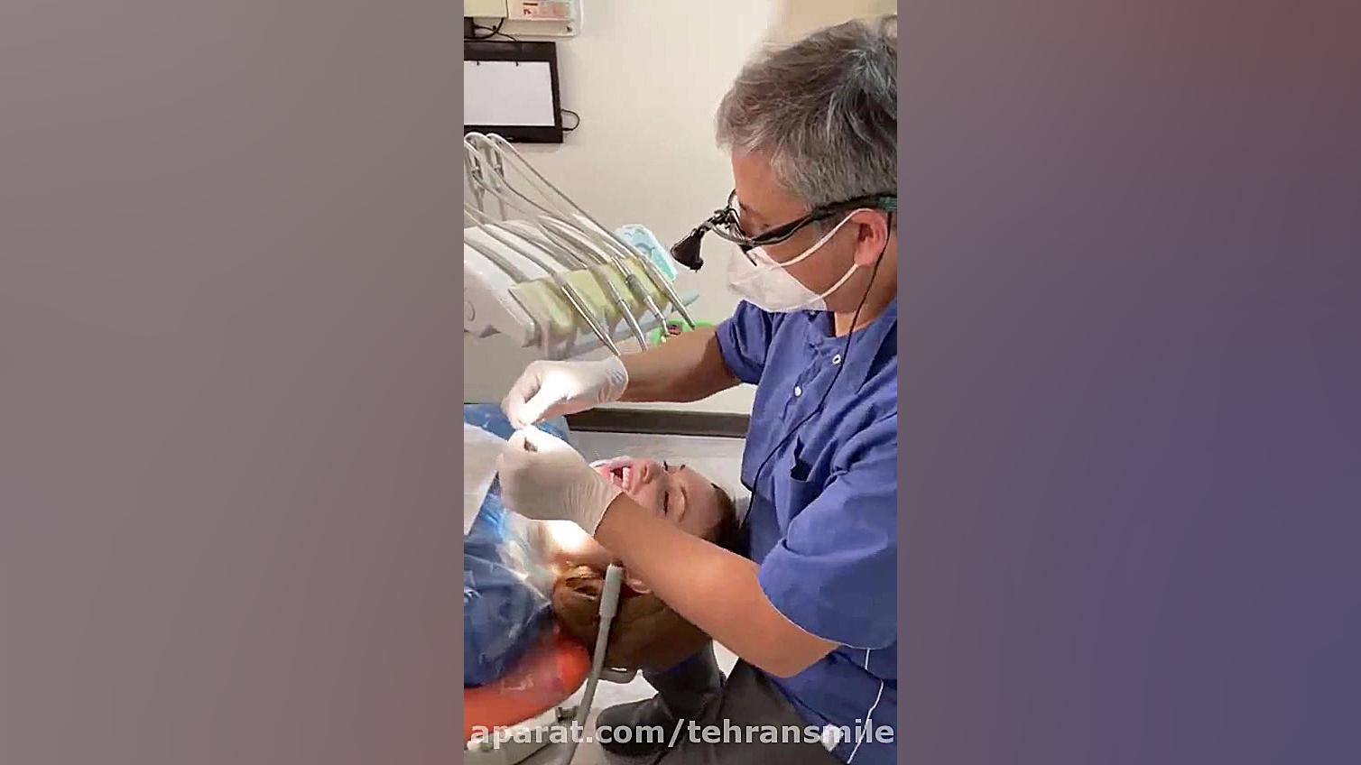 لومینیرز (لمینت) بی تراش دندان در تهران دیسمورفی فاسیال