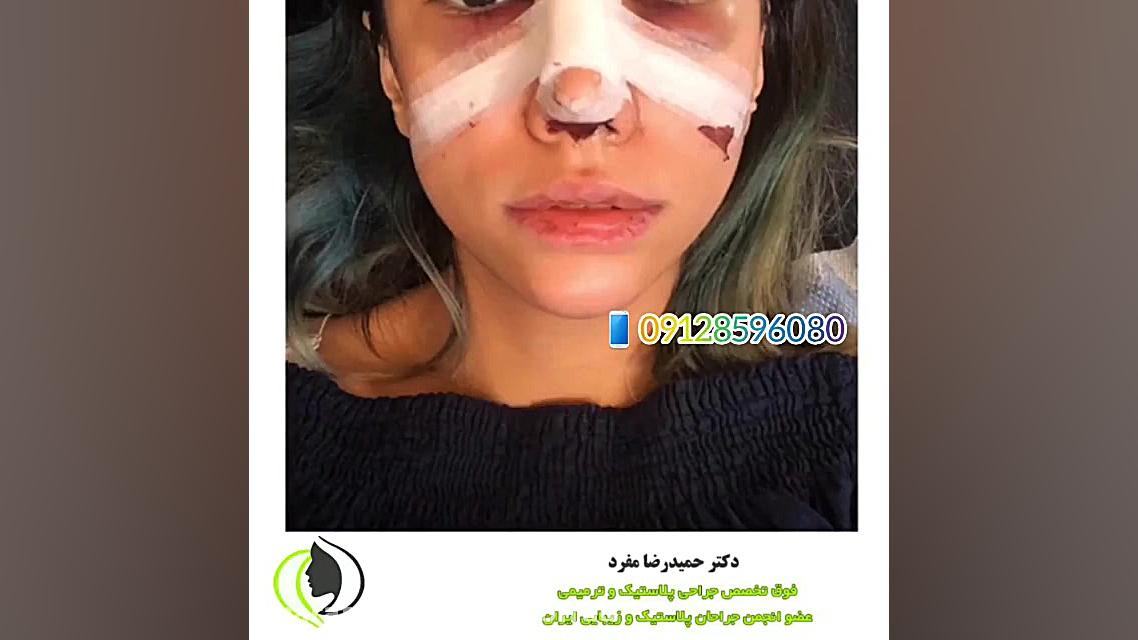 روند بهبودی بعد از عمل زیبایی دکتر حمیدرضا مفرد