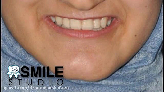 اصلاح لبخند بوسیله ارتودنسی ایریدوتيكان