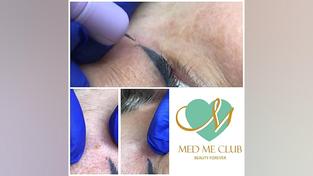 برداشتن خال کنار چشم به روش RF در مجموعه Med Me Club پزشکی دریایی