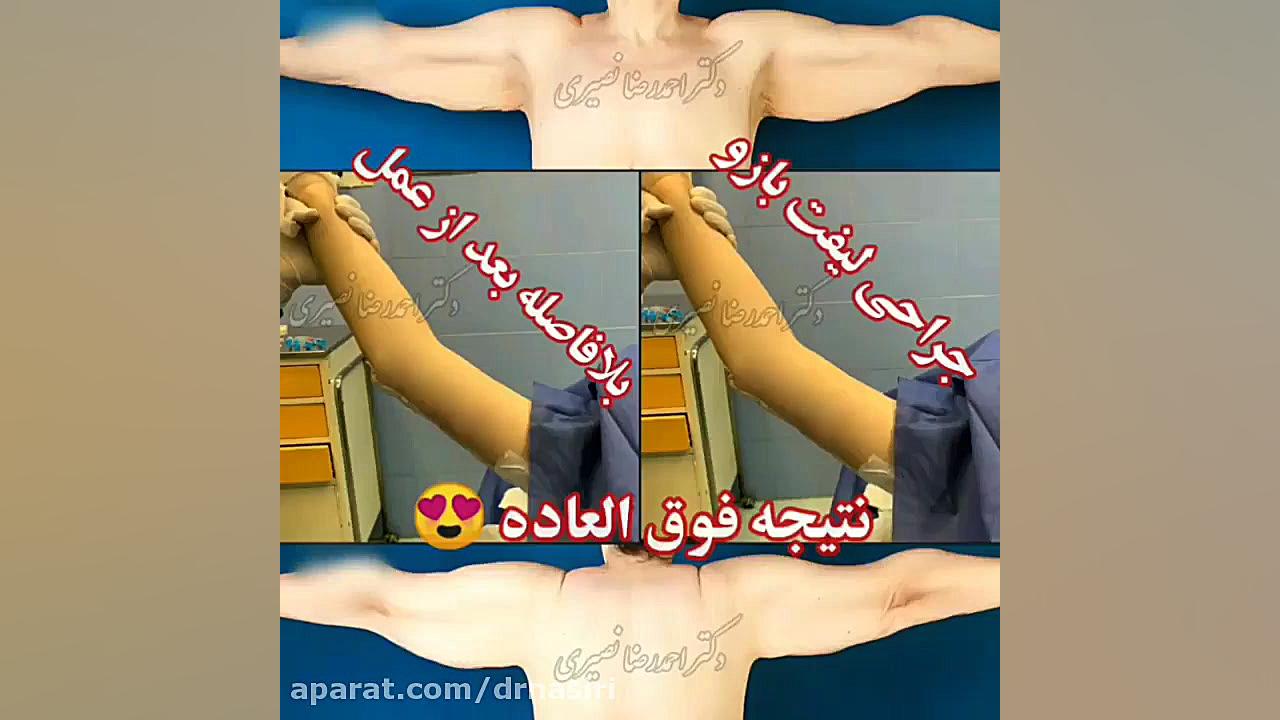 فیلم جراحی لیفت بازو دکتر احمدرضا نصیری