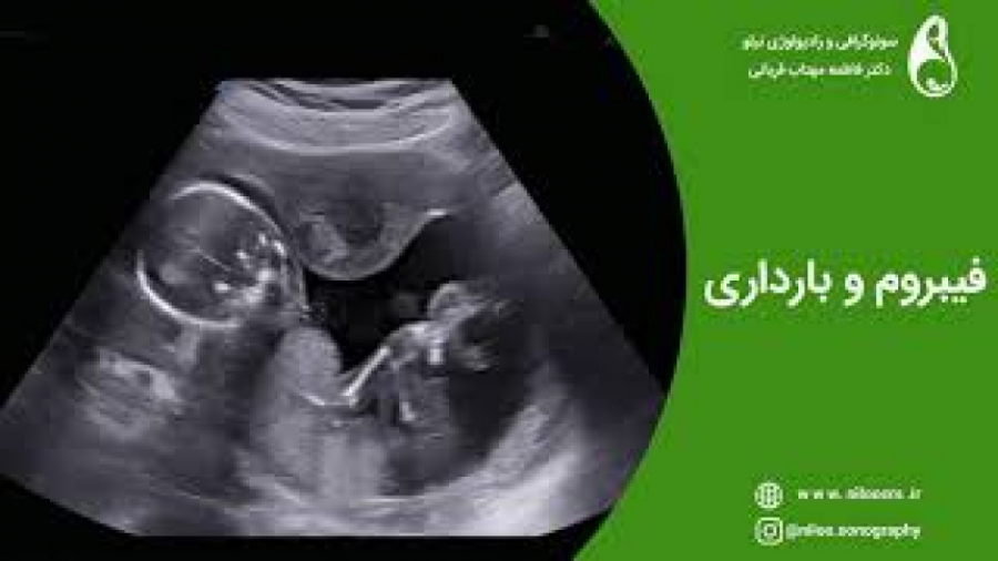 فیبروم در بارداری سونوگرافی نیلو دکتر فاطمه مهتاب قربانی