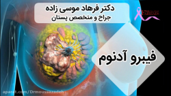 فیبروآدنوم پستان کپسول اندوسکوپی