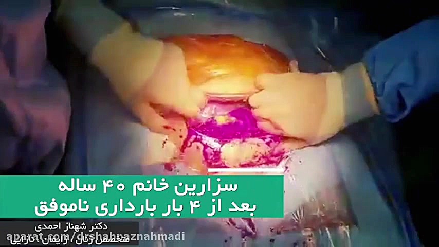 فیلم سزارین بعد از 4 بار بارداری ناموفق دکتر شهناز احمدی