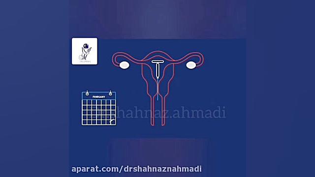 روش جلوگیری از بارداری دکتر شهناز احمدی