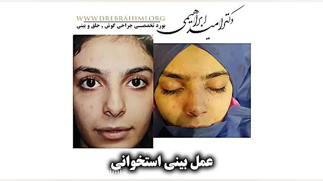 عمل بینی استخوانی قوزدار توسط دکتر امید ابراهیمی، بهترین جراح بینی دکتر امید ابراهیمی