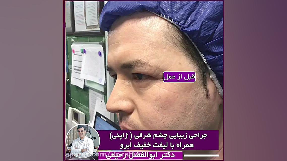 فیلم جراحی زیبایی چشم شرقی PRO-Seq