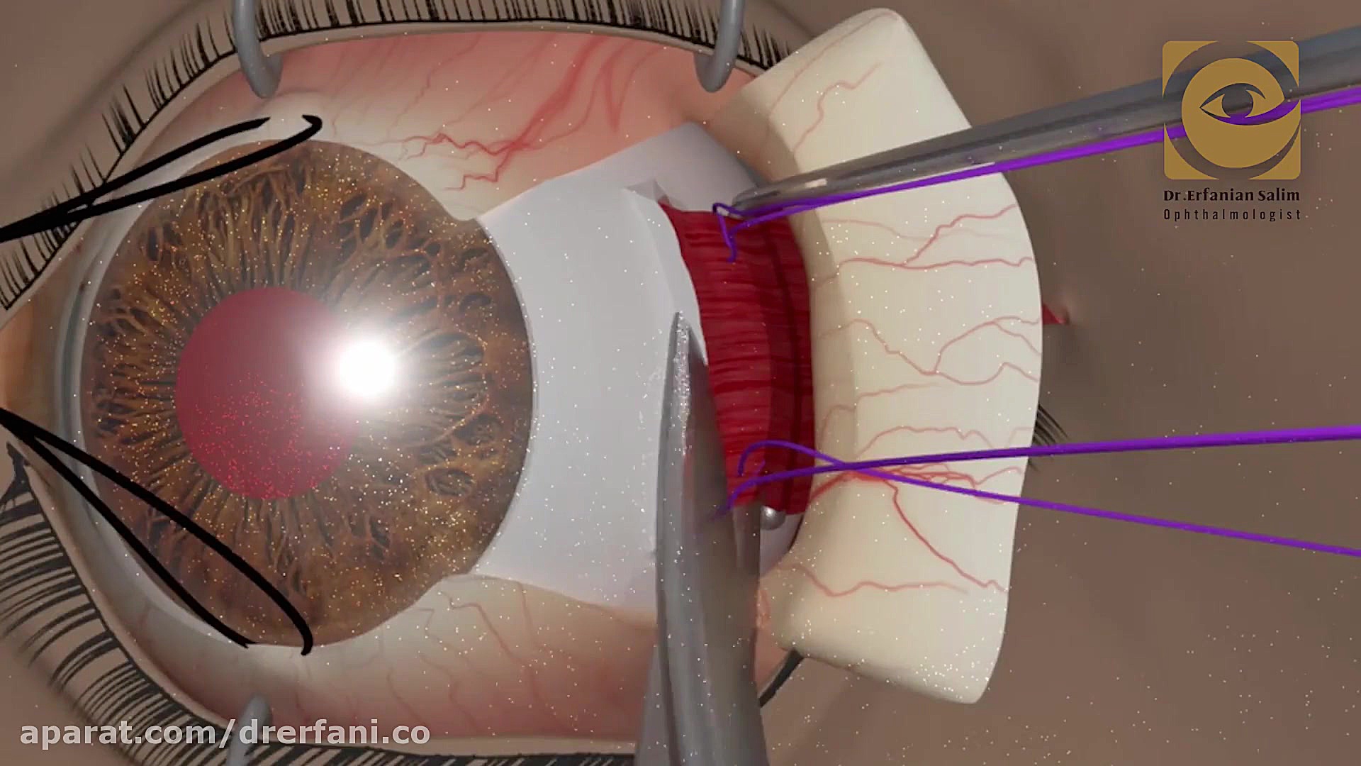 فیلم جراحی انحراف چشم (تکنیک رزکشن) pO2