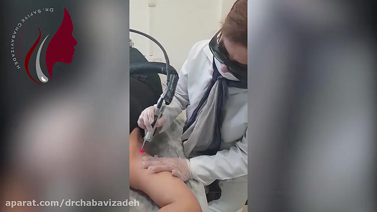 فیلم واقعی لیزر موهای زائد دکتر صفیه چعباوی زاده