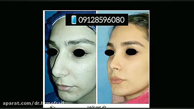 جراحی بینی ( بعد از عمل ) دکتر حمیدرضا مفرد