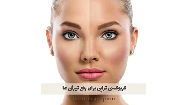 کربوکسی تراپی برای رفع تیرگی های زیر چشم بیماری شوگرن