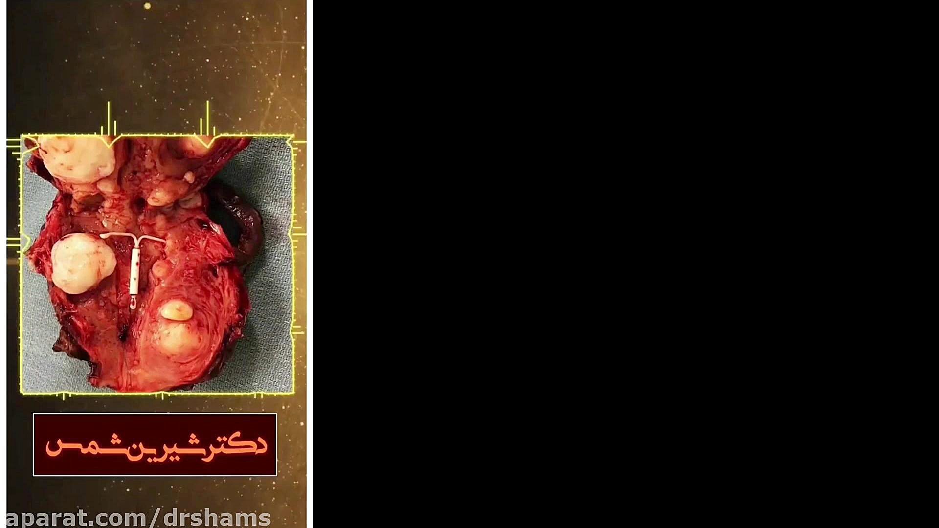 تصویر متفاوتی از رحم دکتر شیرین شمس جراح و متخصص زنان و زایمان