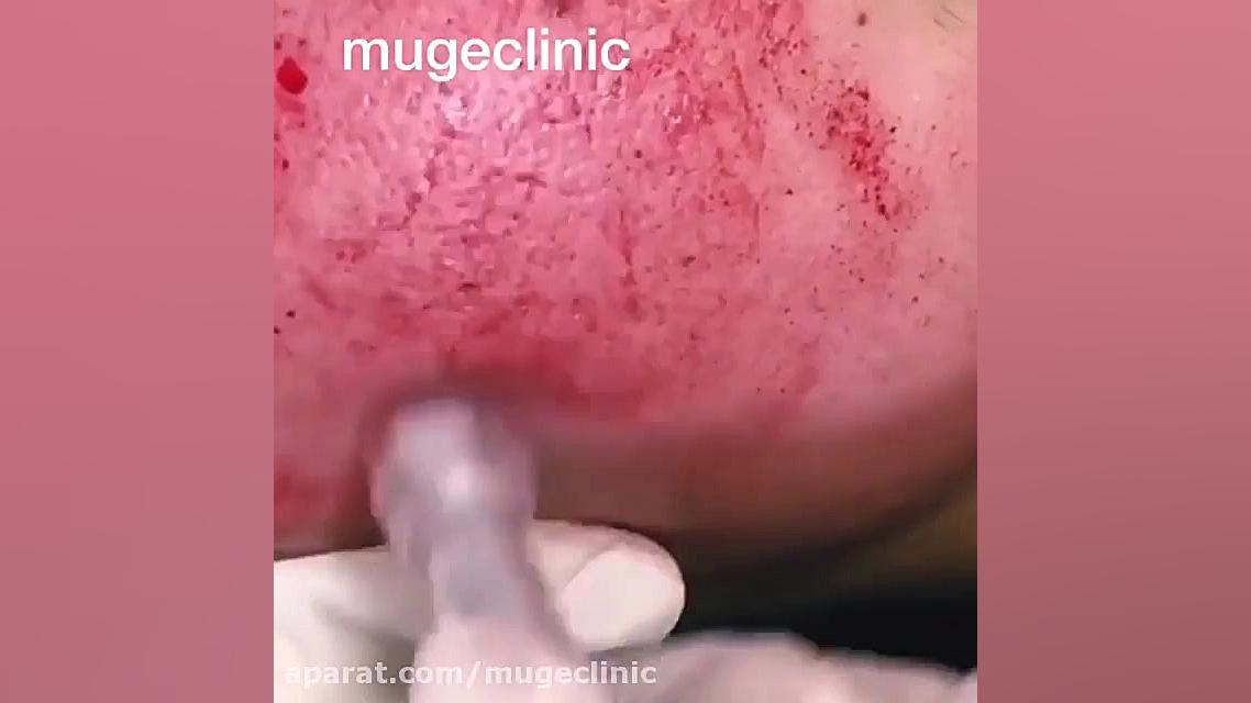 فیلم میکرونیدلینگ کاشت ریش