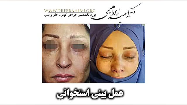 عمل بینی استخوانی توسط دکتر امید ابراهیمی بهترین جراح بیتی استخوانی در تهران دکتر امید ابراهیمی