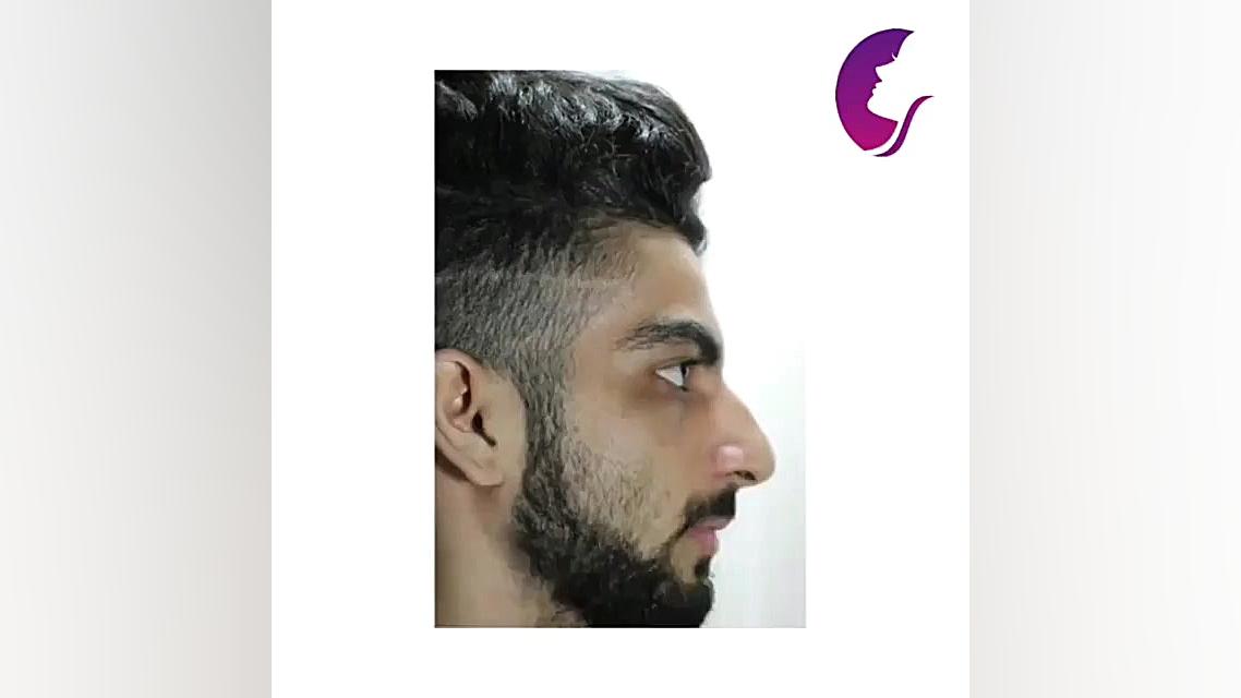 جراحی بینی مردانه دکتر اسماعیل فرزاد فرد - فوق تخصص پلاستیک