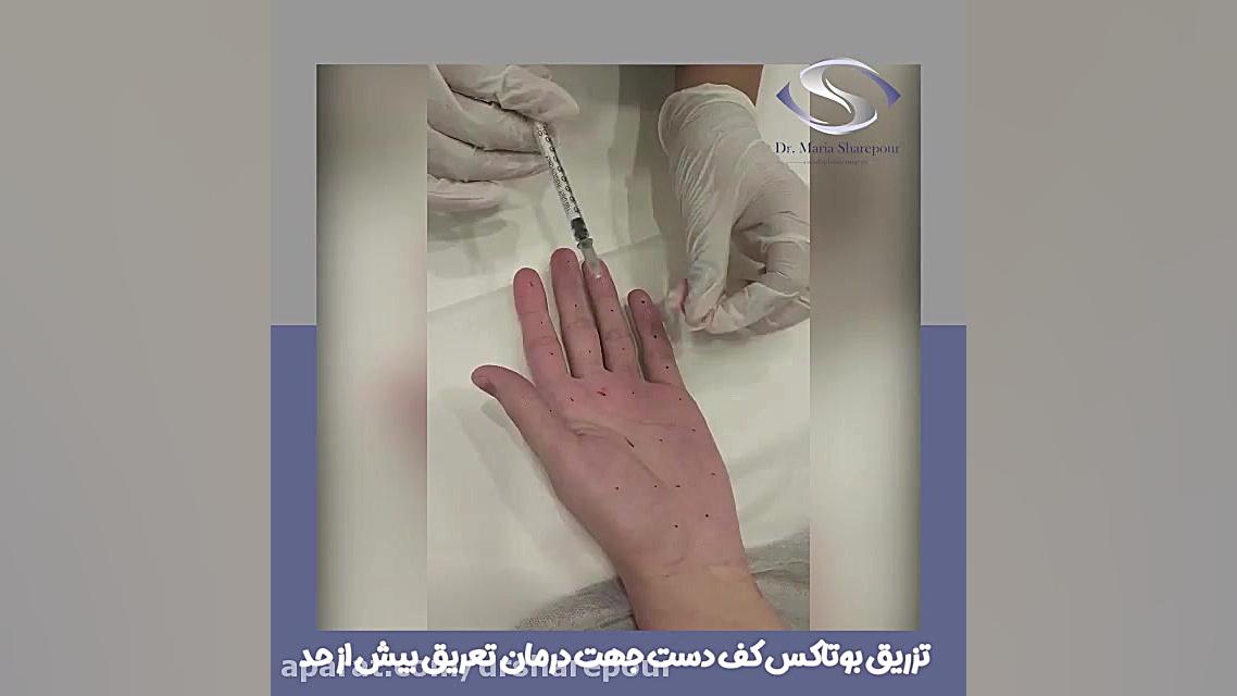 فیلم تزریق بوتاکس به کف دست برای تعریق بیش از حد عصب‌کشی